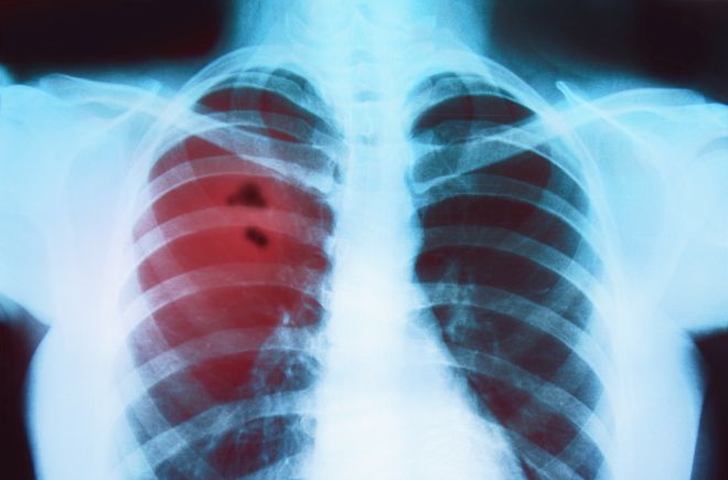 Депздрав предупредил любителей кальяна о высокой токсичности дыма и риске развития рака легких