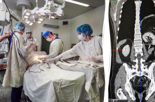 Почка и кишечник на месте легкого: московские хирурги прооперировали мужчину с редкой аномалией